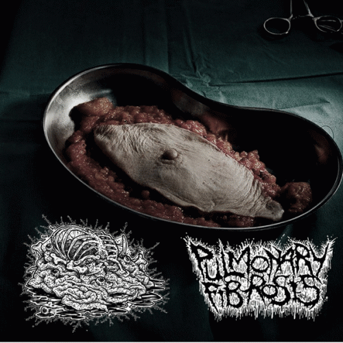 Botched Anastomosis J-Pouch : Cranial Collapses & Shot Gun Induced Brain Hemorrhaging